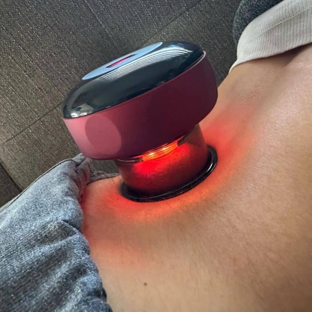 Coppettazione cellulite