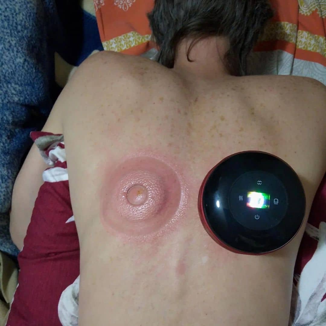 Coppettazione corpo